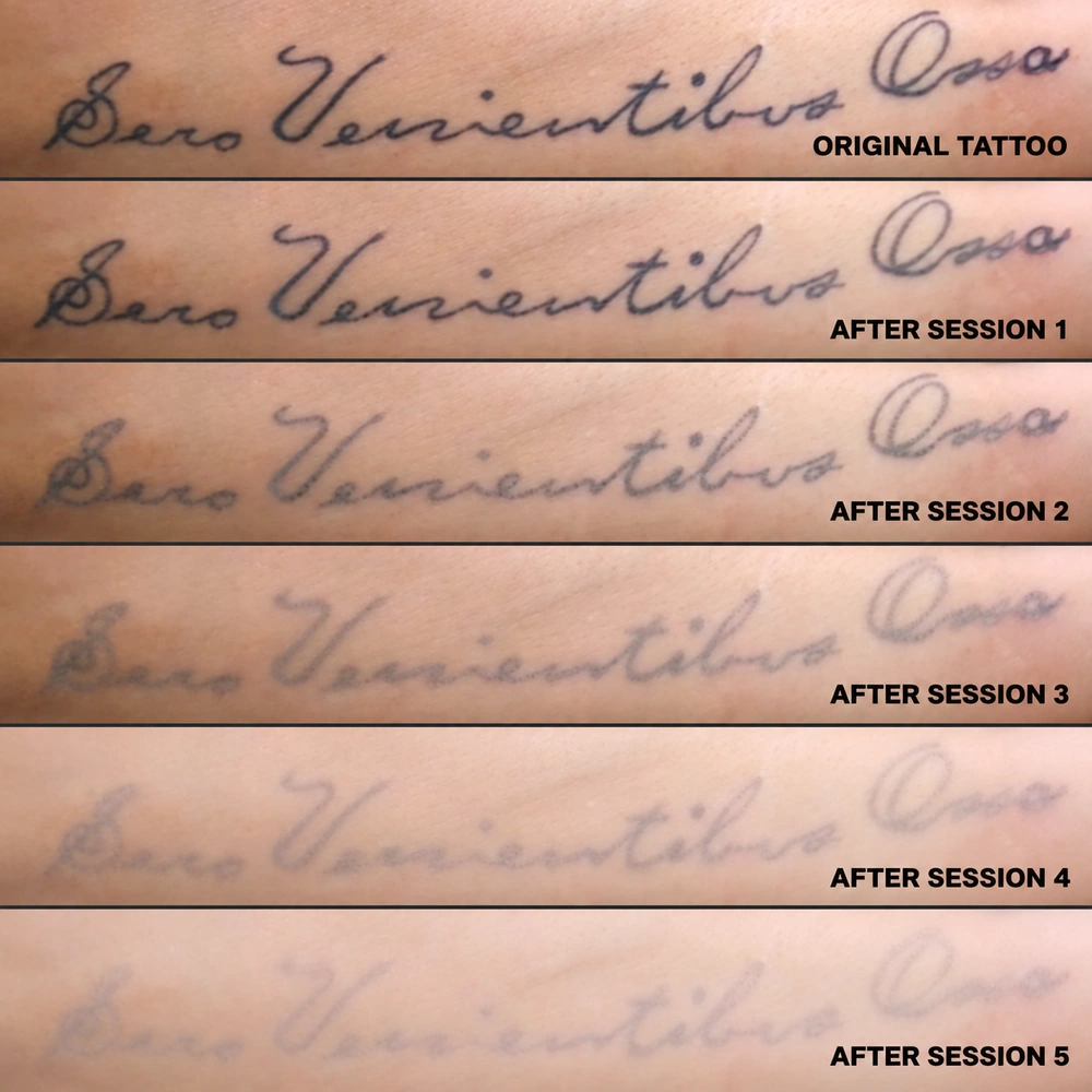 A comparison of tattoo fading stages
