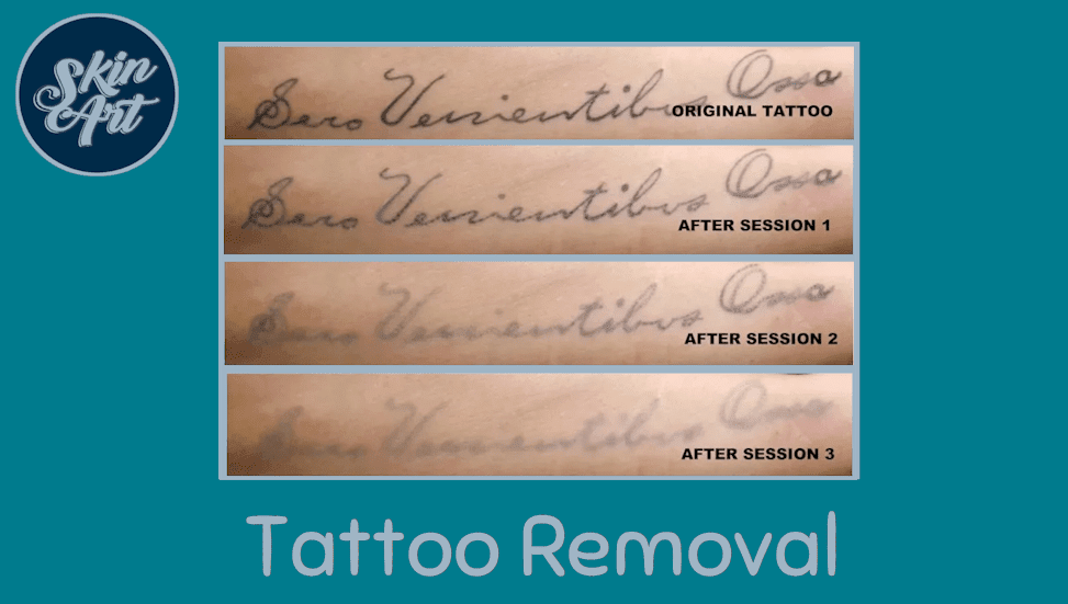 Tattoo Removal Training Course